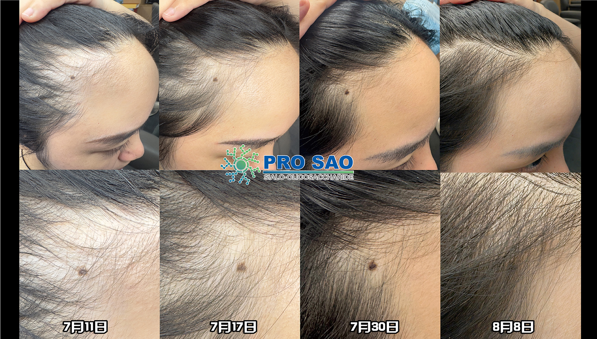 30天头皮护理前后对比