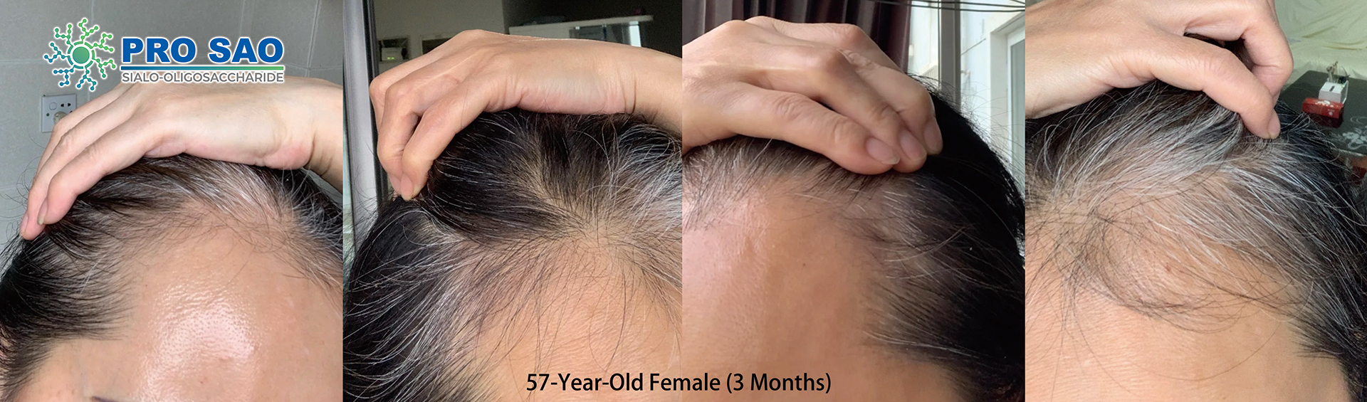 57岁头皮护理前后对比