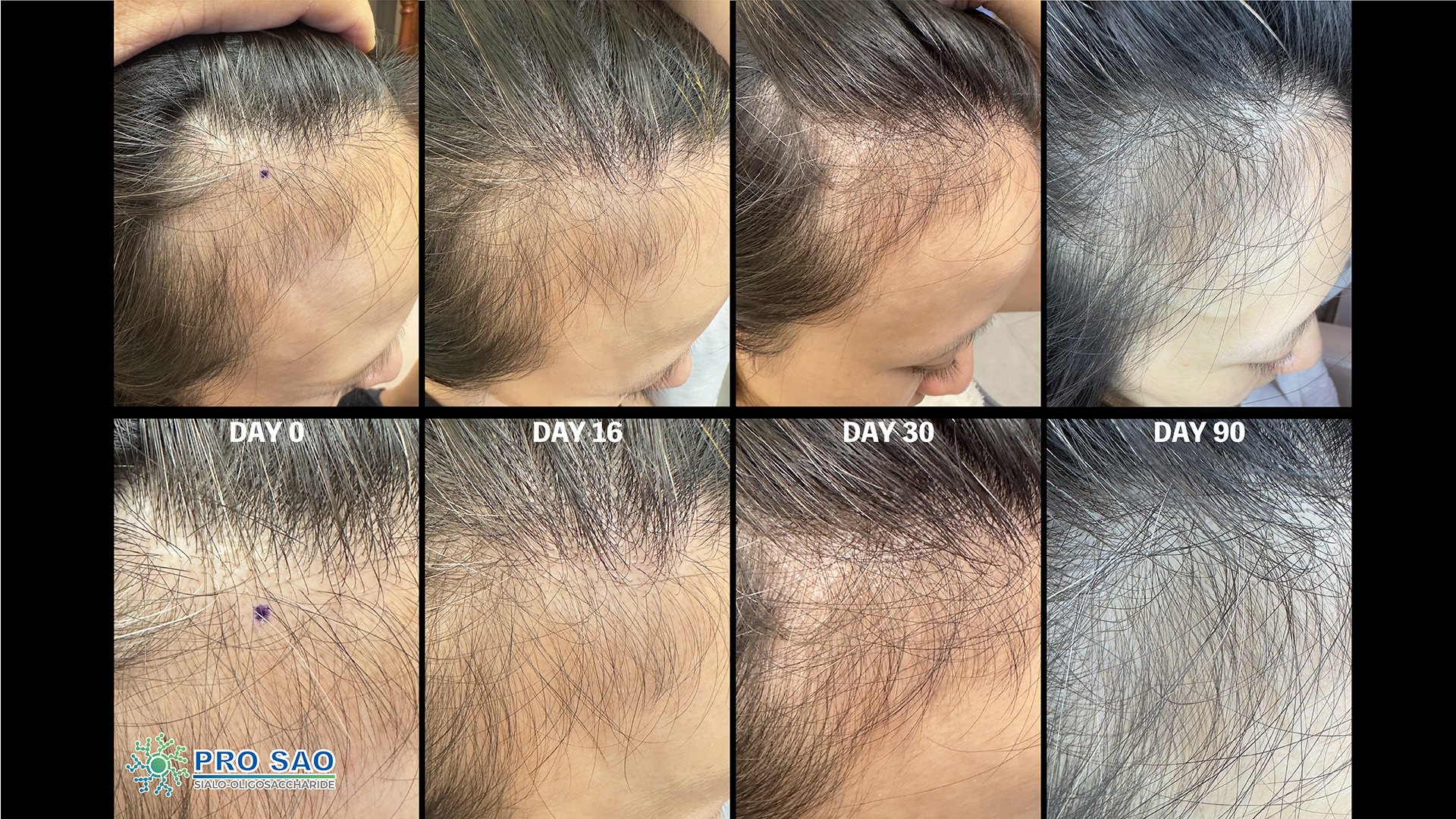 90天头皮护理前后对比